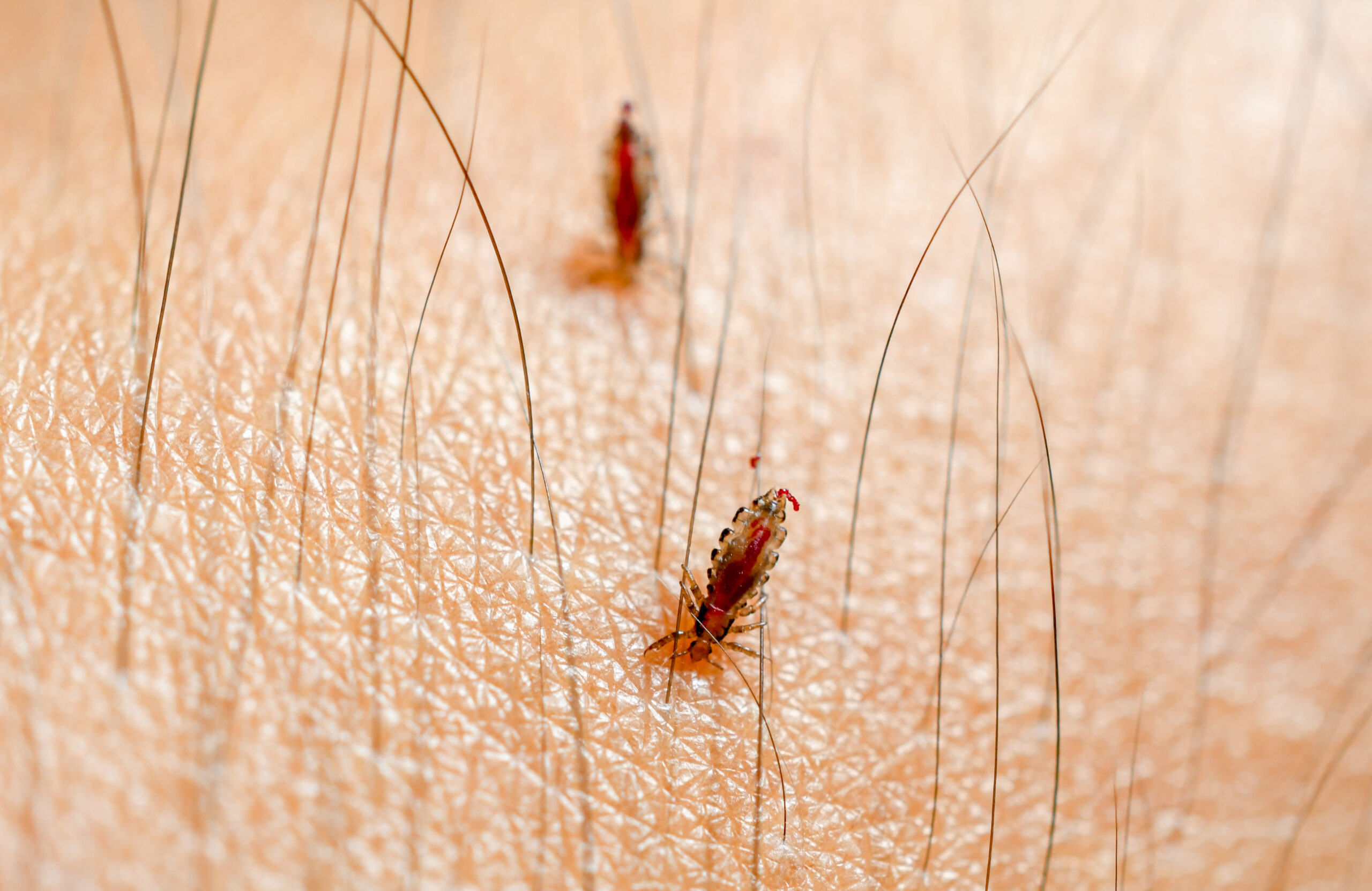 Head Lice feed on scales